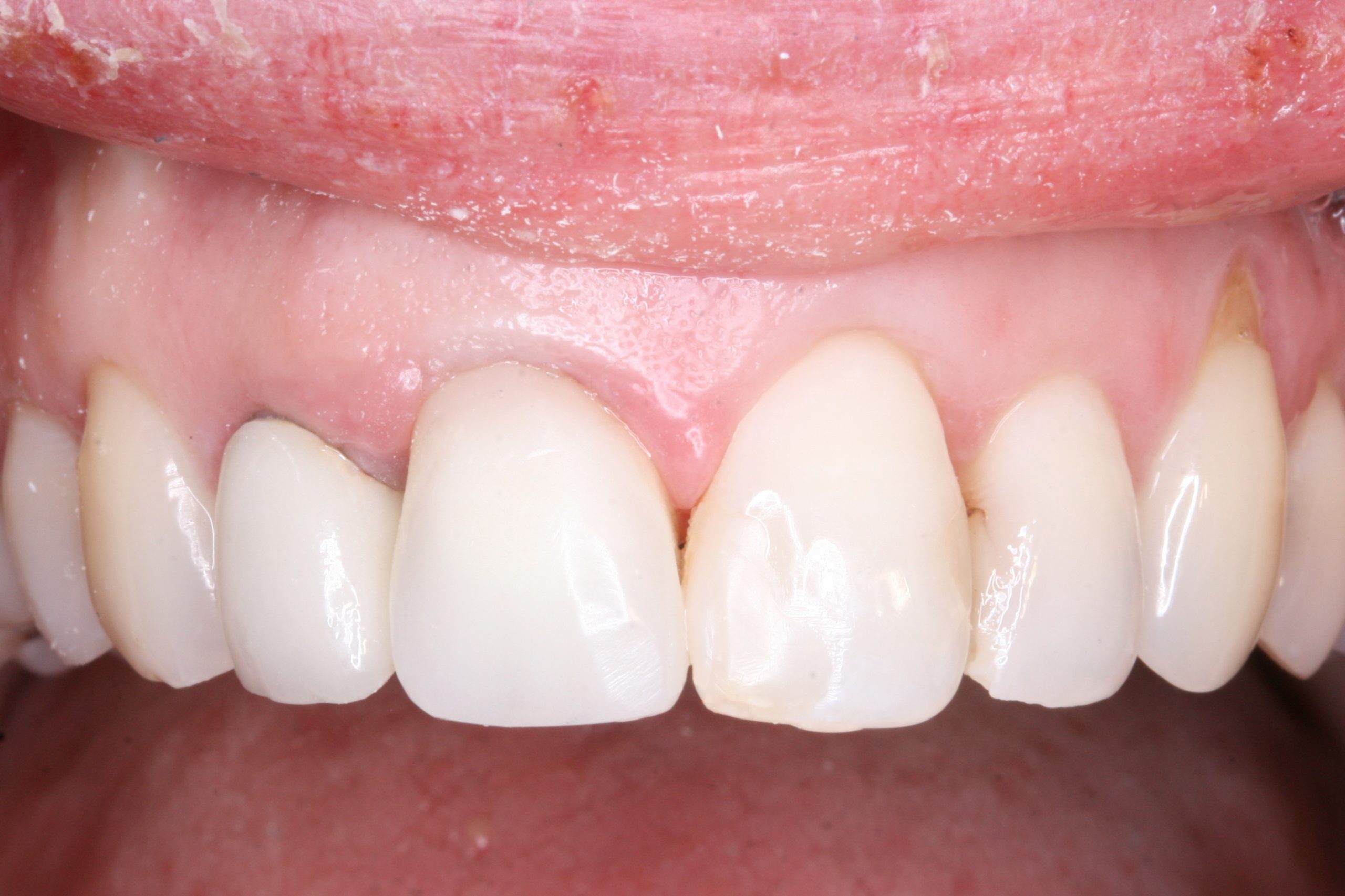 FUD-Dentes-da-frente-Provisório-anterior_2-9-Modificação-do-provisório