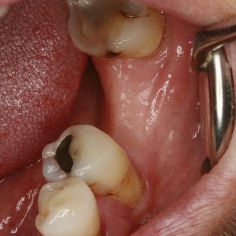 FUD-Dentes-de-trás-1º-molar_1-1-Antes