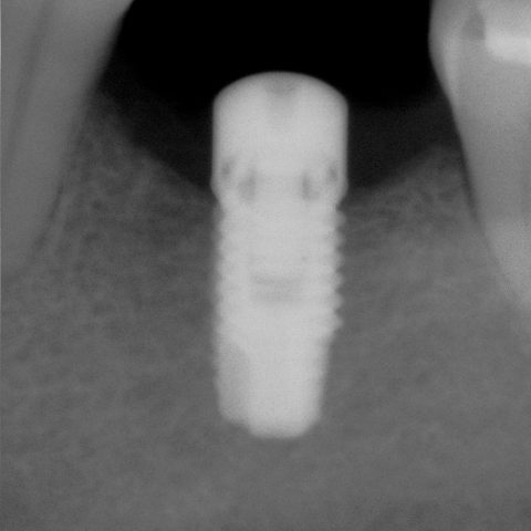 FUD-Dentes-de-trás-1º-molar_1-3-Implante-colocado