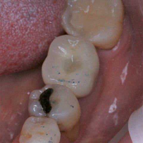 FUD-Dentes-de-trás-1º-molar_1-4-Final