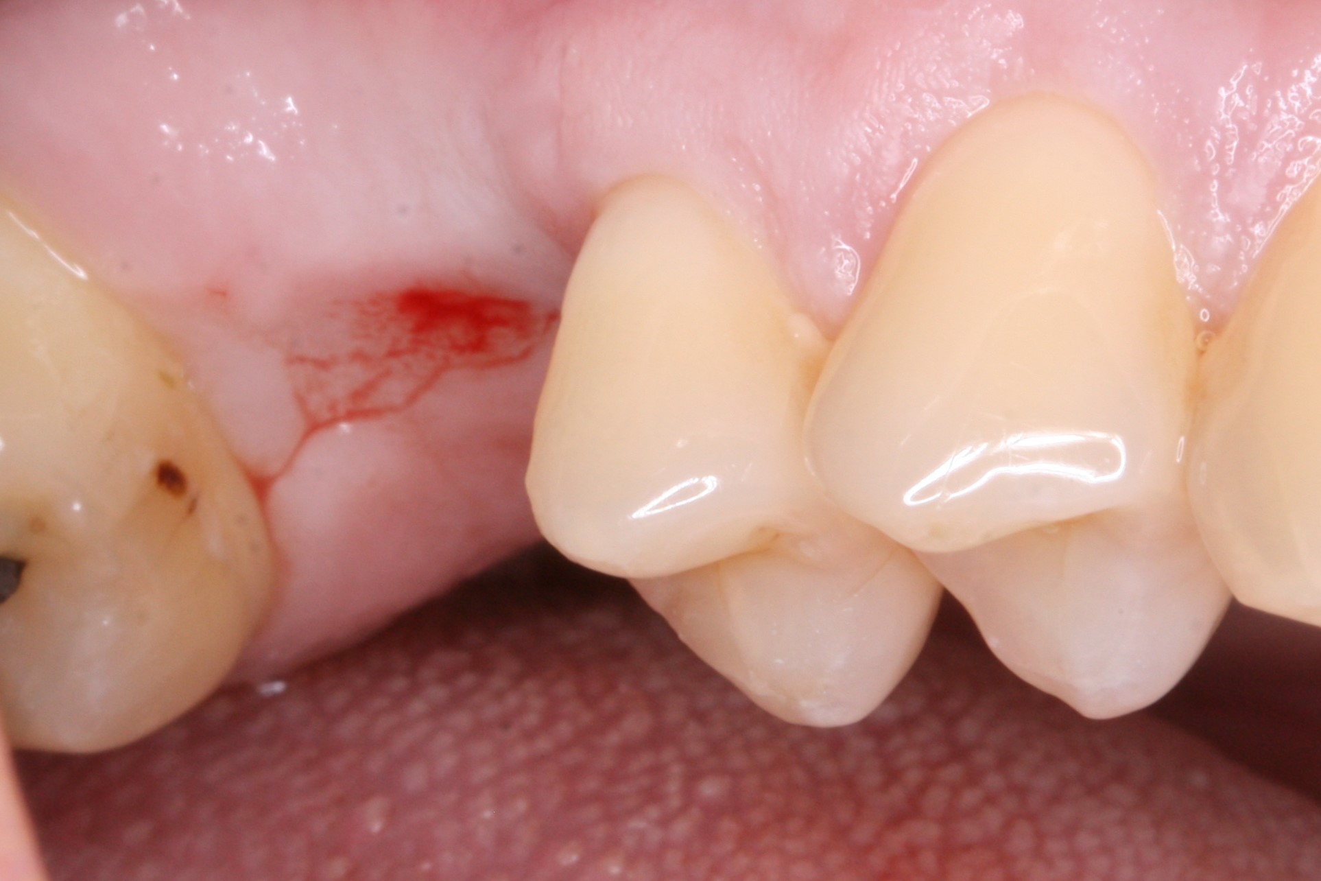 FUD-Dentes-de-trás-1º-molar_2-1-Início