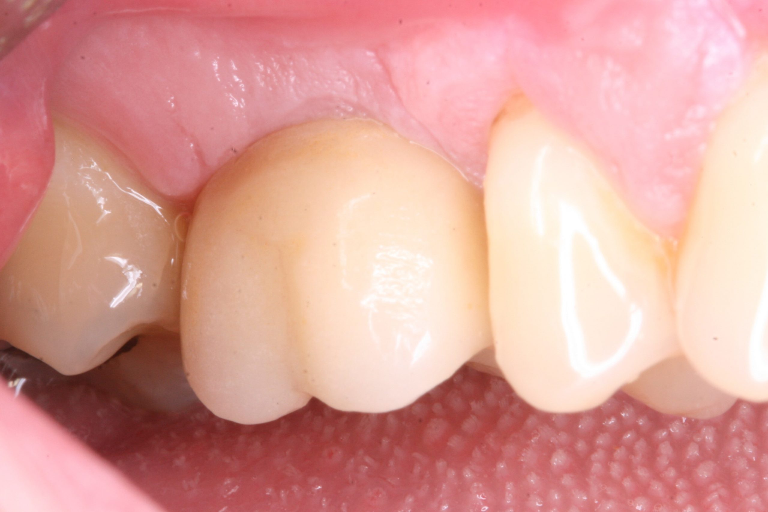 FUD-Dentes-de-trás-1º-molar_2-4-Um-ano-de-evolução
