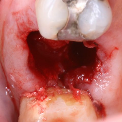 FUD-Dentes-de-trás-1º-molar_3-1-Início