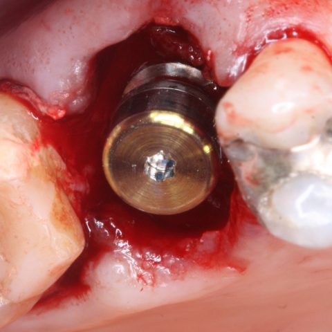 FUD-Dentes-de-trás-1º-molar_3-2-Implante-e-pilares-colocados