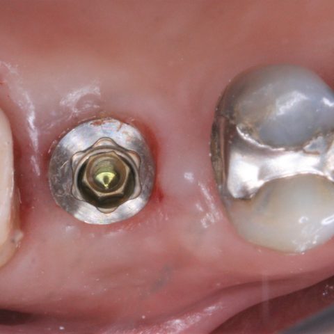 FUD-Dentes-de-trás-1º-molar_3-3-Cicatrização-dos-tecidos-após-3-meses