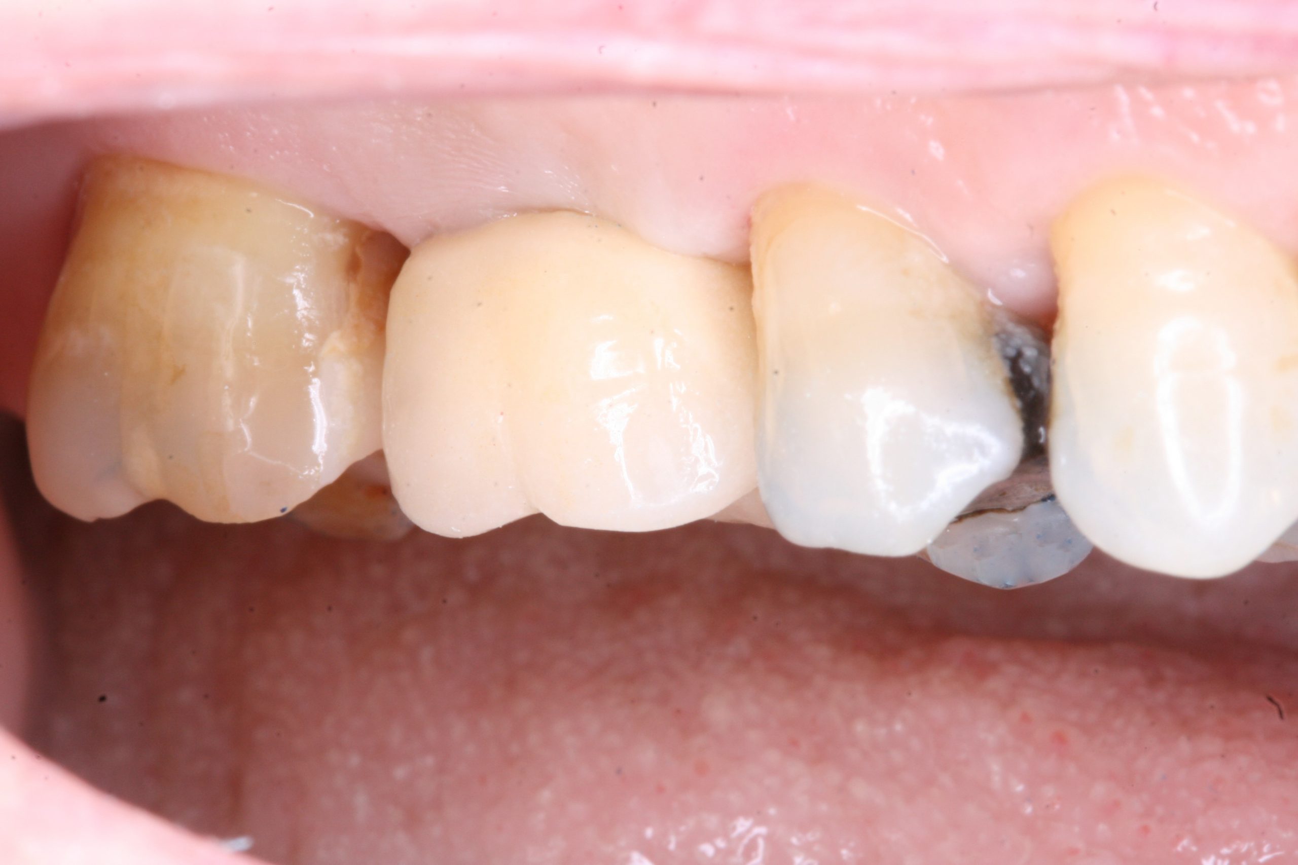 FUD-Dentes-de-trás-1º-molar_3-4-Colocação-da-coroa-definitiva