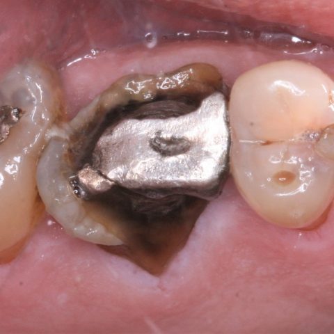 FUD-Dentes-de-trás-1º-molar_3-dtr-1-Início