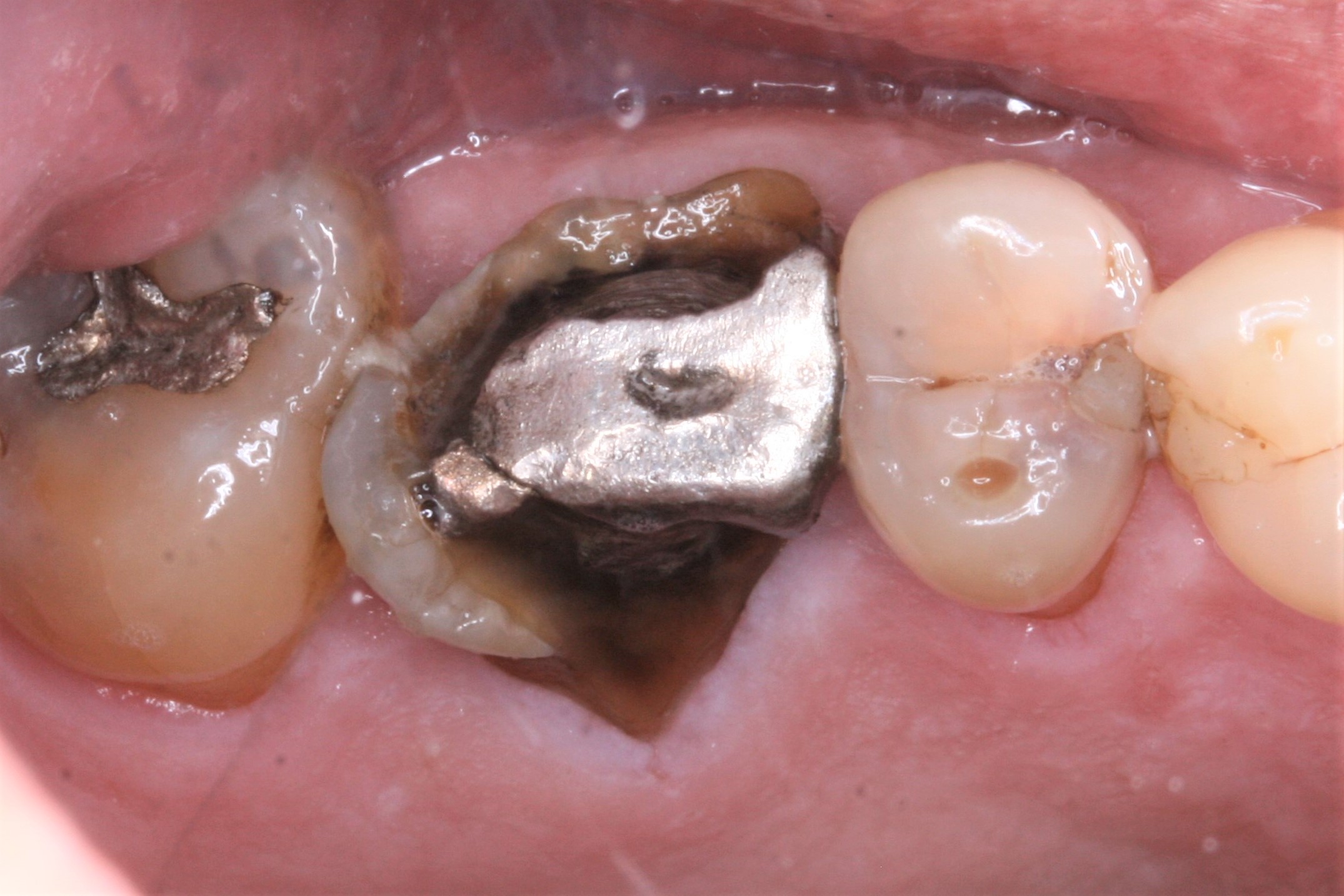 FUD-Dentes-de-trás-1º-molar_3-dtr-1-Início
