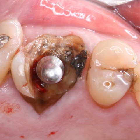 FUD-Dentes-de-trás-1º-molar_3-dtr-2-Prepatação-do-leito-implantar-através-das-raizes