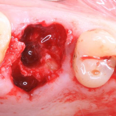 FUD-Dentes-de-trás-1º-molar_3-dtr-3-Extração-das-raizes-e-leito-implantar
