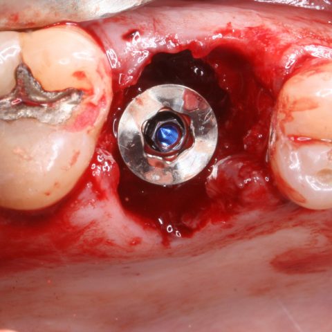 FUD-Dentes-de-trás-1º-molar_3-dtr-4-Implante-e-pilar-colocados
