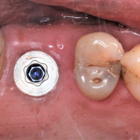 FUD-Dentes-de-trás-1º-molar_3-dtr-6-Cicatrização-ao-fim-de-3-meses