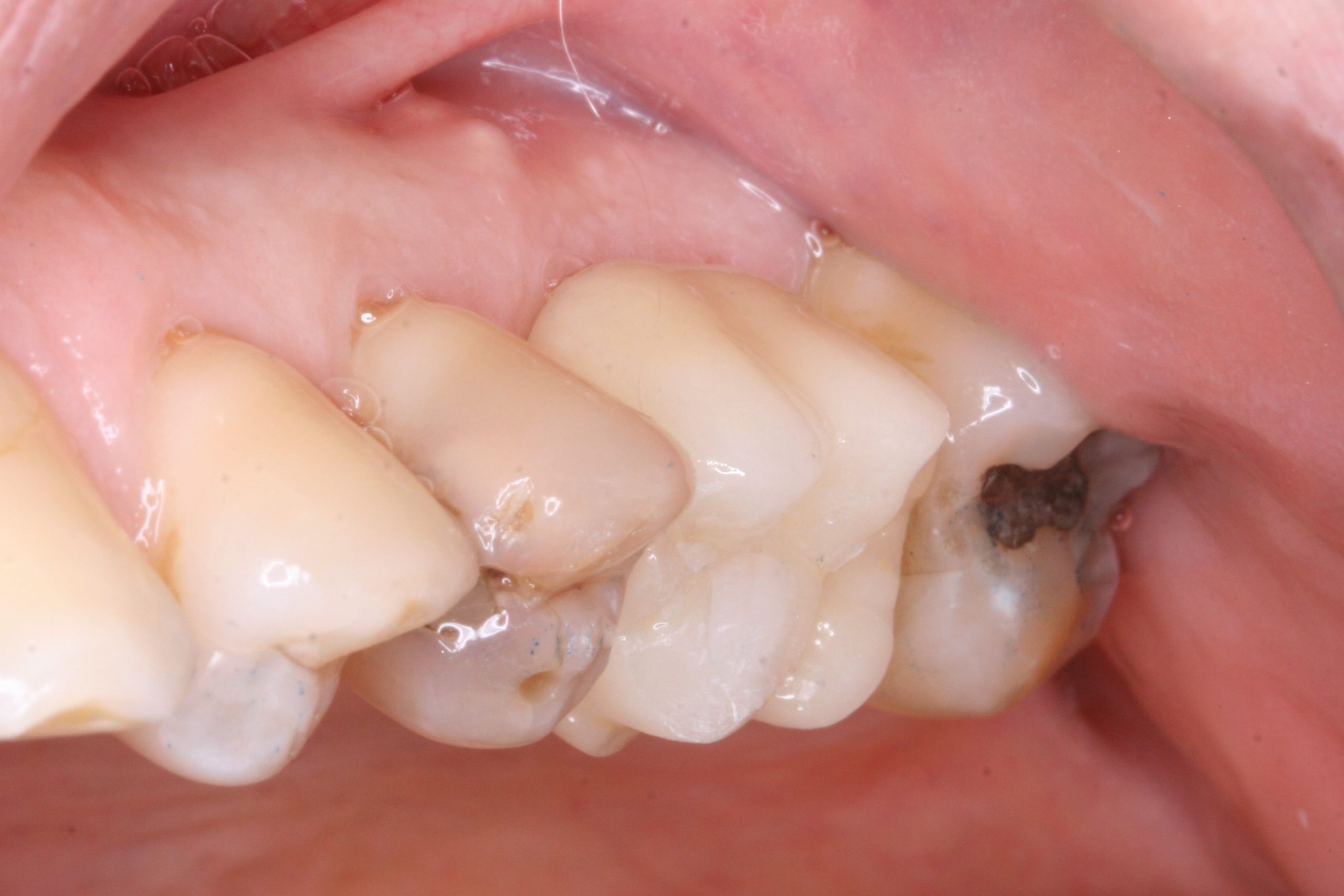 FUD-Dentes-de-trás-1º-molar_3-dtr-8-Coroa-definitiva