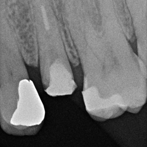 FUD-Dentes-de-trás-Provisório-posterior_1-1-Rx-inicial