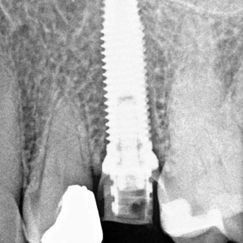 FUD-Dentes-de-trás-Provisório-posterior_1-2-Rx-com-implante-colocado-após-extração