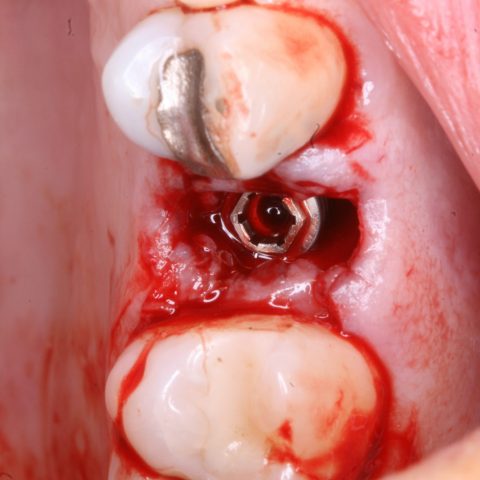 FUD-Dentes-de-trás-Provisório-posterior_1-3-implante-no-alvéolo-dentário