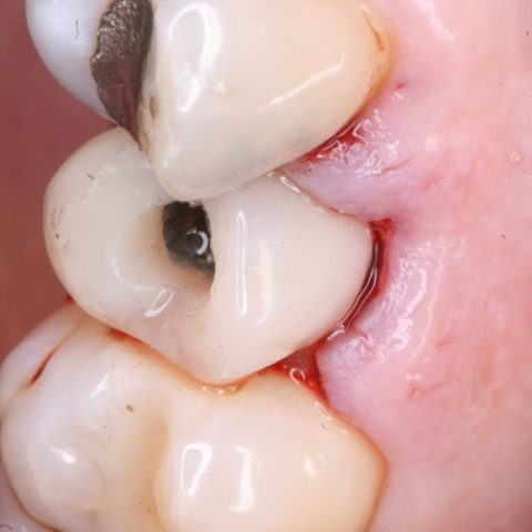 FUD-Dentes-de-trás-Provisório-posterior_1-4-provisório