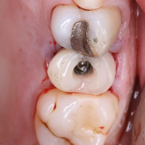 FUD-Dentes-de-trás-Provisório-posterior_1-5-dente-provisório