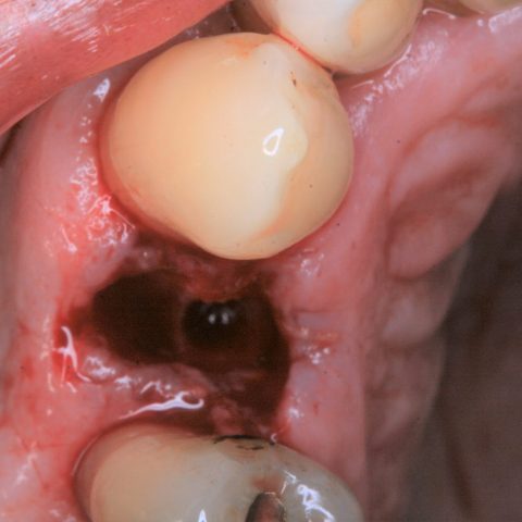 FUD-Dentes-de-trás-Provisório-posterior_2-1-Início