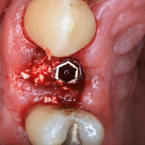 FUD-Dentes-de-trás-Provisório-posterior_2-3-Implante-colocado-e-xenoenxerto