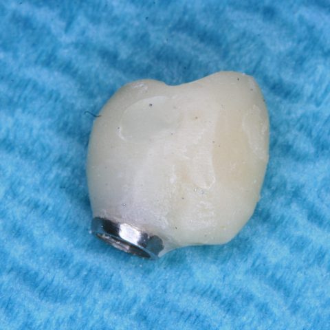FUD-Dentes-de-trás-Provisório-posterior_2-4-Coroa-provisória-em-acrílico