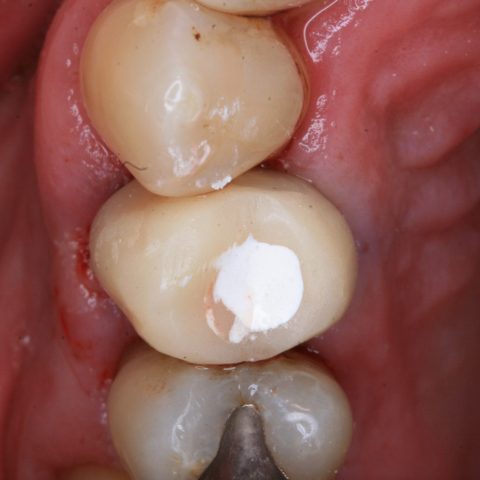 FUD-Dentes-de-trás-Provisório-posterior_2-5-Coroa-provisória-aparafusada-ao-implante