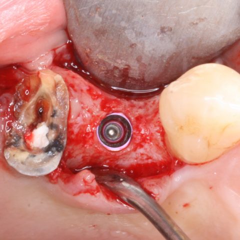 FUD-Dentes-de-trás-Pré-molar-superior-2-Implante-colocado