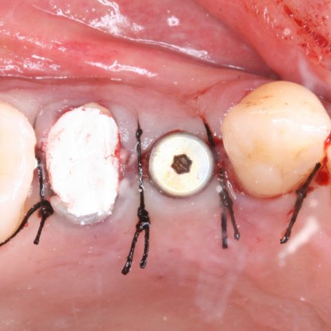 FUD-Dentes-de-trás-Pré-molar-superior-3-Pós-operatório-imediato