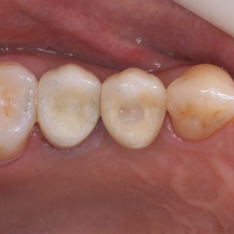FUD-Dentes-de-trás-Pré-molar-superior-5-Aspeto-final
