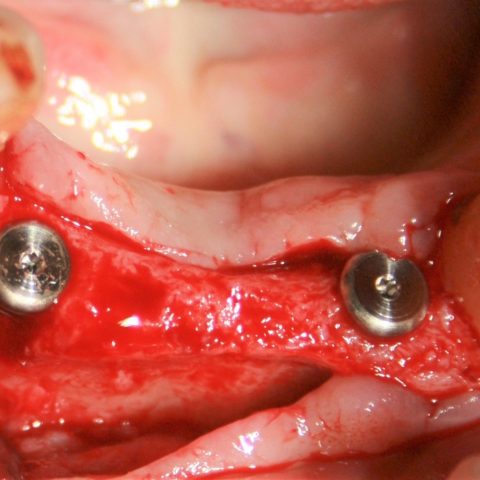 FVD-Anteriores-2-implantes-colocados