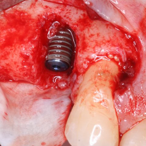 RO-Simultaneamente-à-colocação-do-implante_1-2-Implante-colocado-e-membrana-de-colagénio-por-palatino
