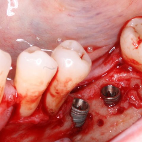 RO-Simultaneamente-à-colocação-do-implante_2-3-Implantes-colocados
