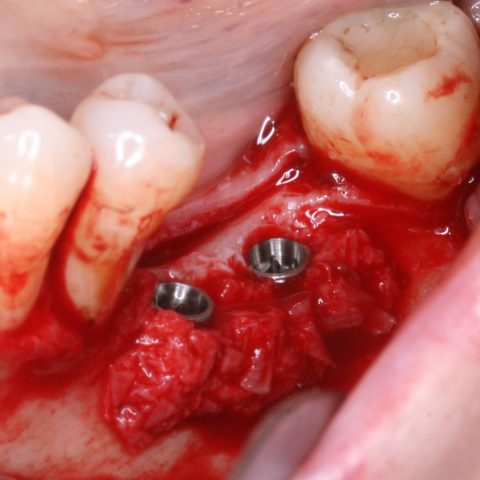 RO-Simultaneamente-à-colocação-do-implante_2-4-Osso-autólogo-em-contacto-com-a-superfície-do-implante