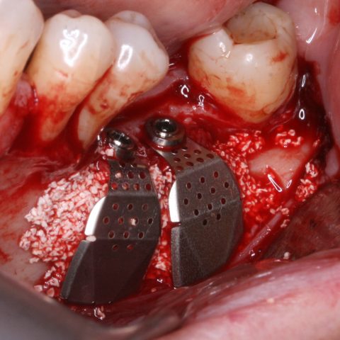RO-Simultaneamente-à-colocação-do-implante_2-6-Membranas-de-titânio-aparafusadas-aos-implantes