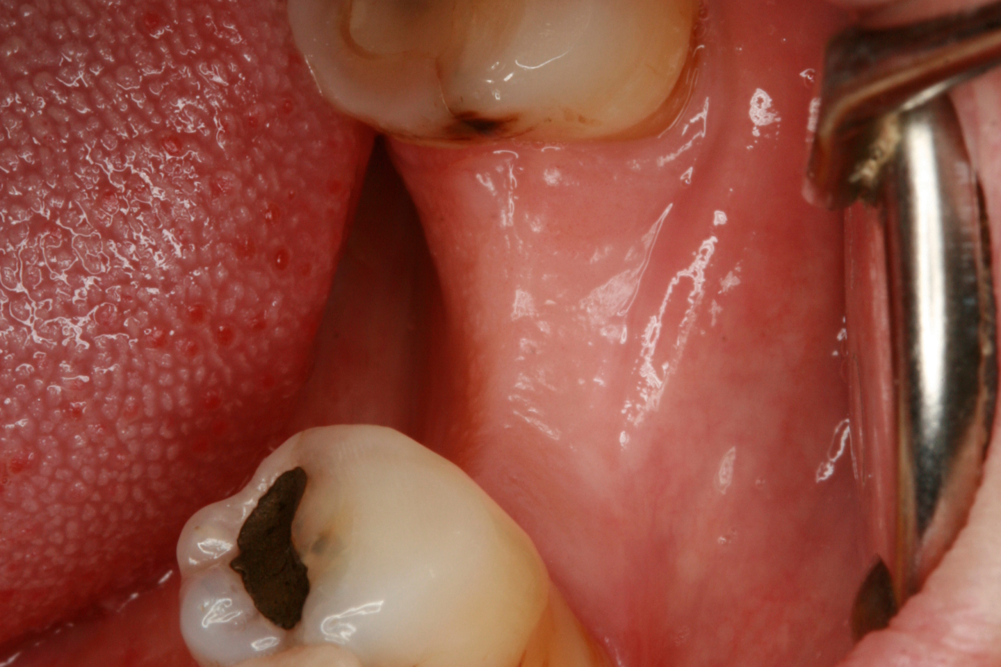 FUD-Dentes-de-trás-1º-molar_1-1-Antes-fixed
