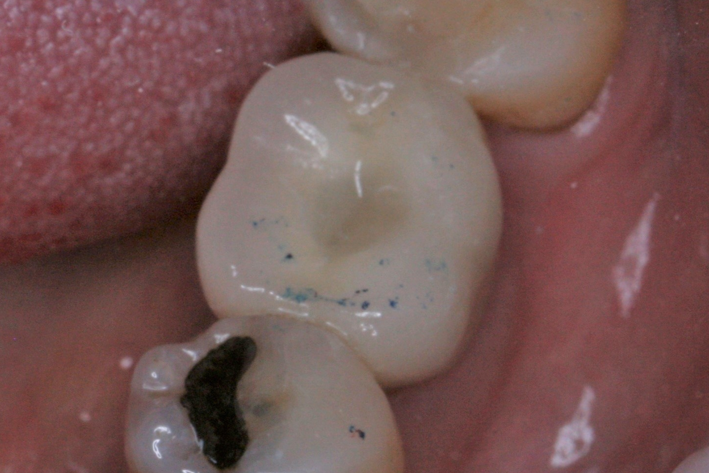 FUD-Dentes-de-trás-1º-molar_1-4-Final-fixed