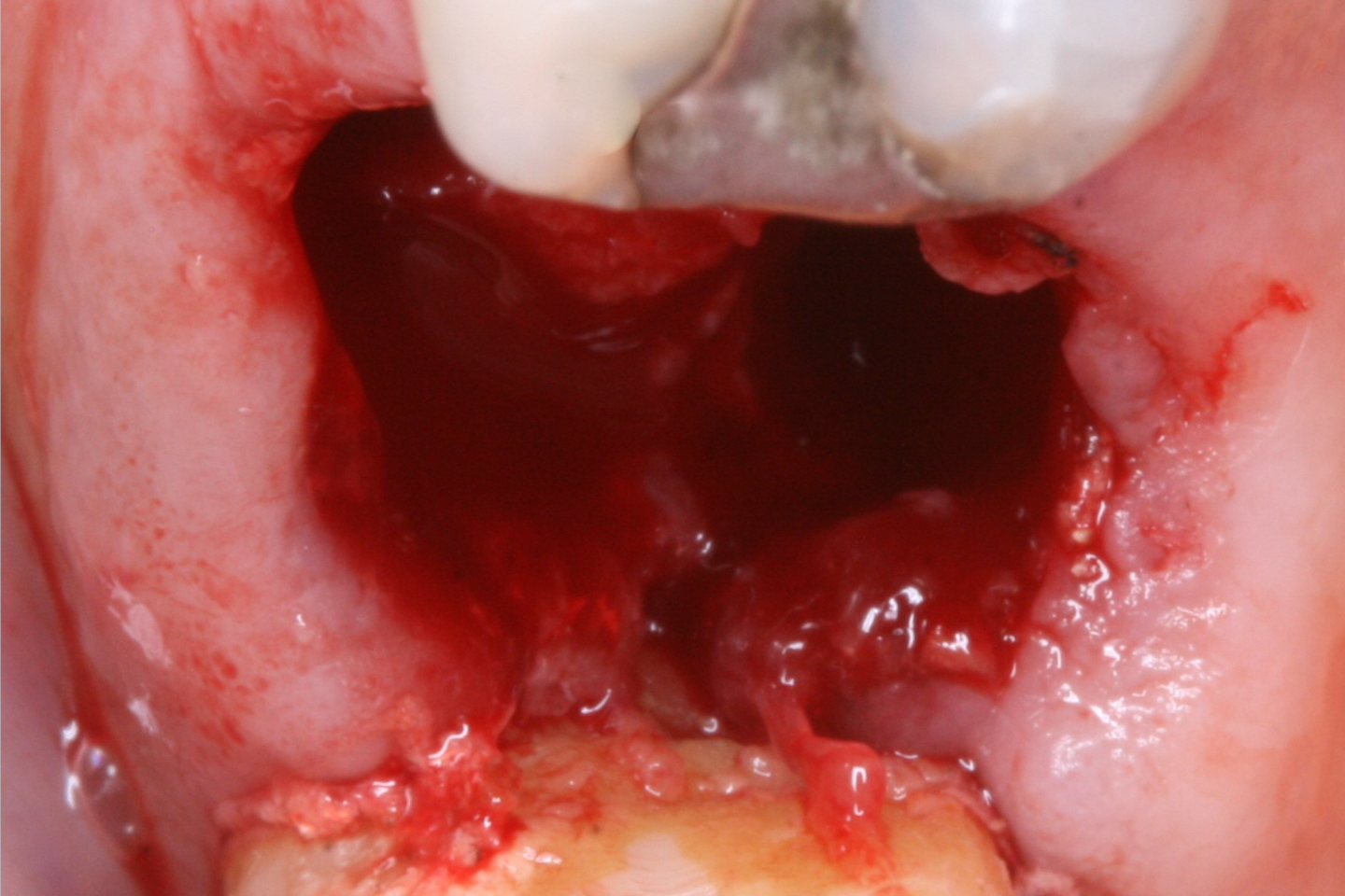 FUD-Dentes-de-trás-1º-molar_3-1-Início-fixed