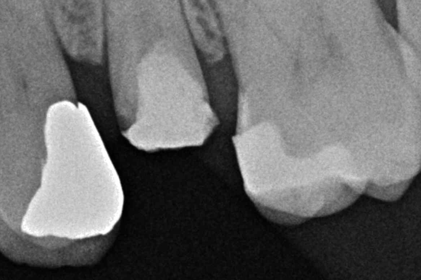 FUD-Dentes-de-trás-Provisório-posterior_1-1-Rx-inicial-fixed
